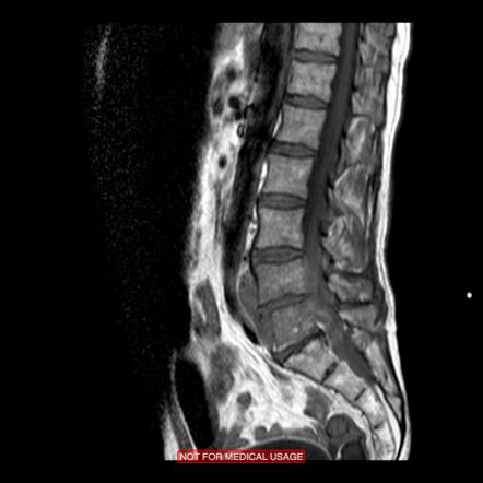 Pyogenic spondylitis | Radiology Reference Article | Radiopaedia.org