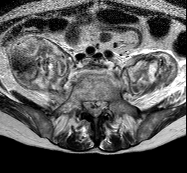 Spondylodiscitis | Radiology Reference Article | Radiopaedia.org