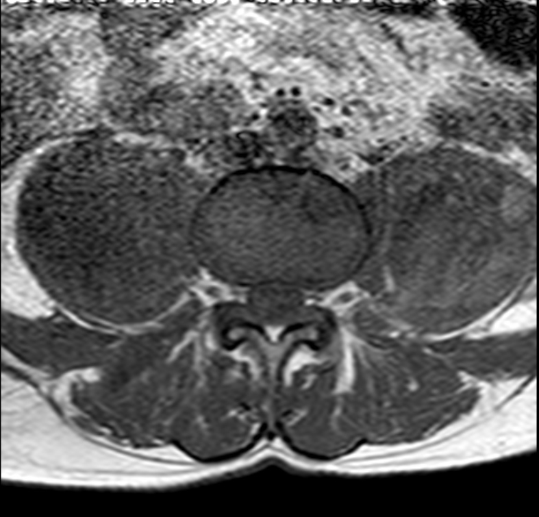 Spondylodiscitis With Bilateral Psoas Abscesses | Image | Radiopaedia.org