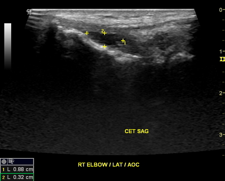 Common extensor tendon tear - elbow | Radiology Case | Radiopaedia.org