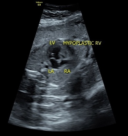 Hypoplastic right heart syndrome | Radiology Reference Article ...