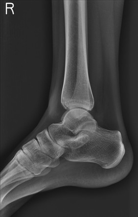 Anterior talofibular ligament injury | Image | Radiopaedia.org