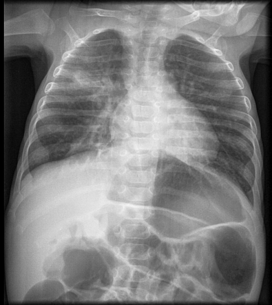 Isolated H-shaped tracheoesophageal fistula without esophageal atresia ...