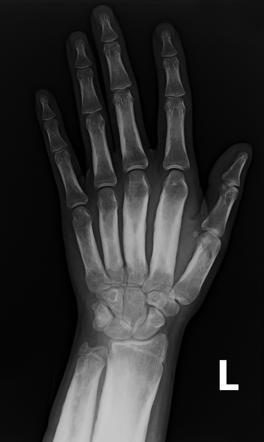 Camurati-Engelmann disease | Radiology Reference Article | Radiopaedia.org