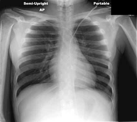 Camurati-Engelmann disease | Radiology Reference Article | Radiopaedia.org