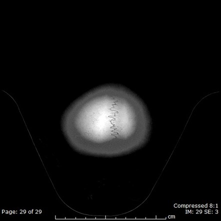 Camurati-Engelmann disease | Radiology Reference Article | Radiopaedia.org