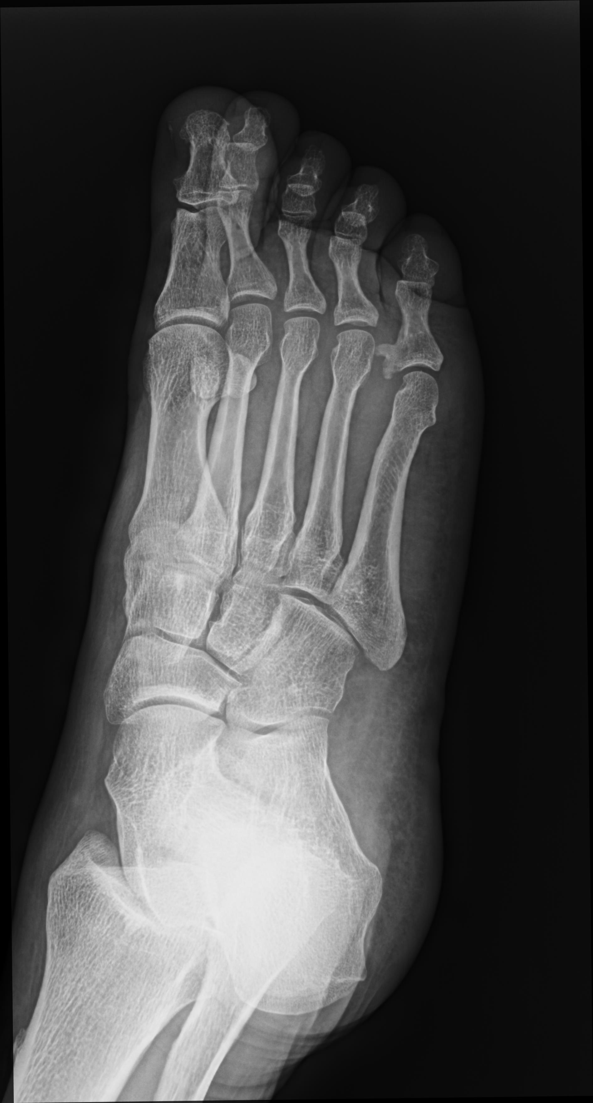 Exostosis Off Tibia Musculoskeletal Case Studies