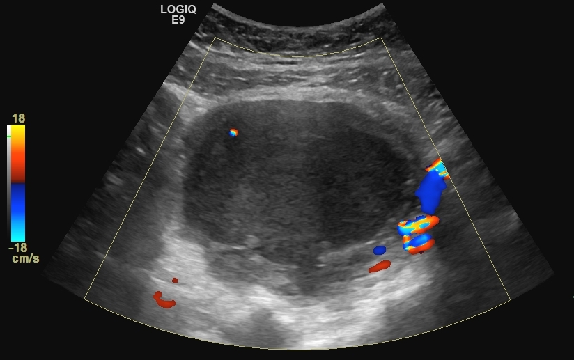 Herlyn-Werner-Wunderlich syndrome with endometrioma and hematosalpinx ...