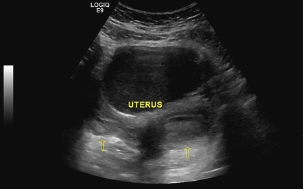 Herlyn-Werner-Wunderlich syndrome with endometrioma and hematosalpinx ...