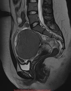 Herlyn-Werner-Wunderlich syndrome with endometrioma and hematosalpinx ...