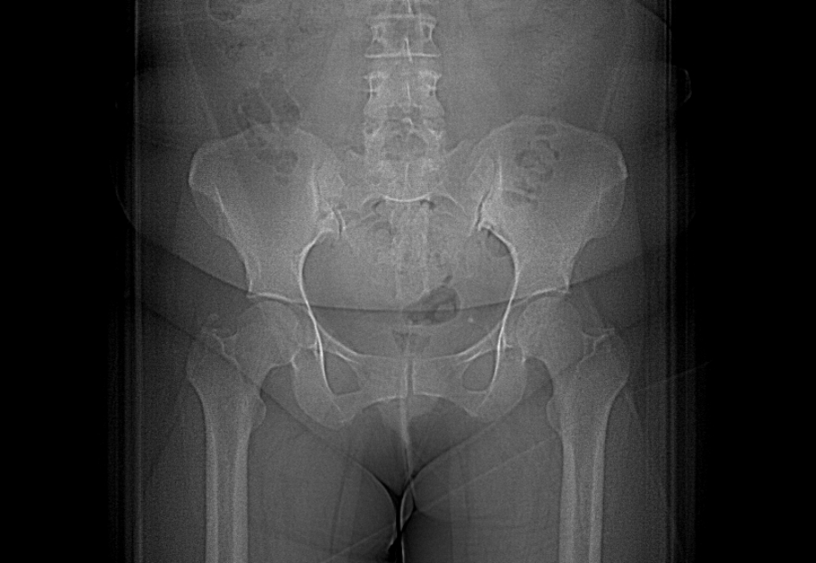 Calcific Tendinitis Of The Gluteus Medius Muscle Image Radiopaedia Org