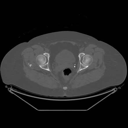 Calcific Tendinitis Of The Gluteus Medius Muscle Image Radiopaedia Org