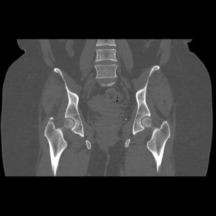 Calcific Tendinitis Of The Gluteus Medius Muscle Image Radiopaedia Org