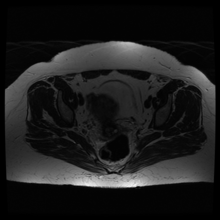 Calcific Tendinitis Of The Gluteus Medius Muscle Image Radiopaedia Org