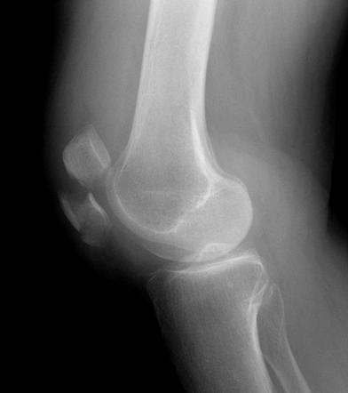 Patella fracture | Radiology Case | Radiopaedia.org