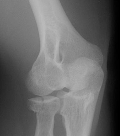 Radial head fracture | Radiology Case | Radiopaedia.org