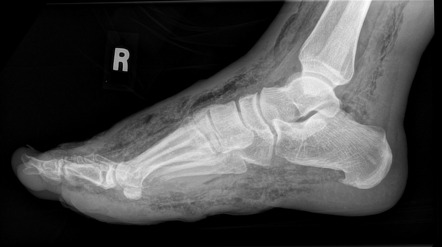 Necrotising fasciitis | Radiology Reference Article | Radiopaedia.org