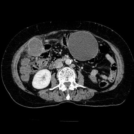 Peritoneal and hepatic hydatid cysts | Image | Radiopaedia.org