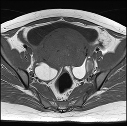 Adenomyosis - ovarian endometriomas | Radiology Case | Radiopaedia.org