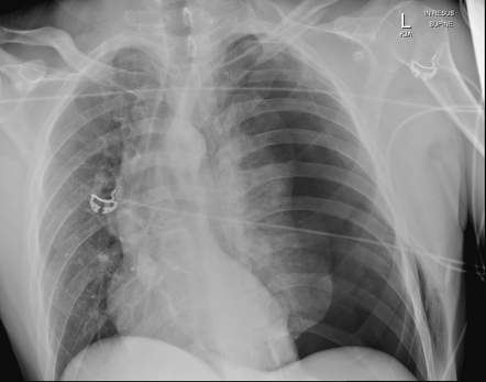 Tension pneumothorax | Radiology Case | Radiopaedia.org