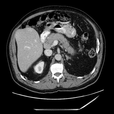 Autoimmune Pancreatitis Diagnostic Criteria Radiology Reference Article Radiopaedia Org