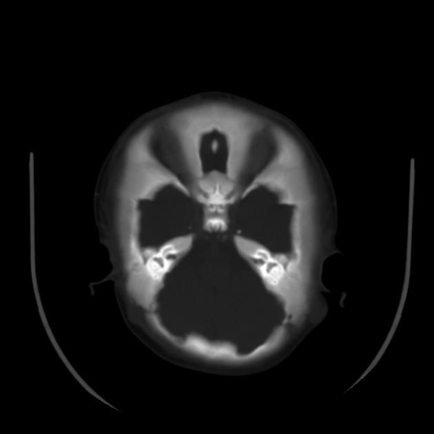 Osteopetrosis | Radiology Reference Article | Radiopaedia.org