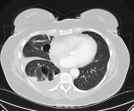 Birt-Hogg-Dubé syndrome | Radiology Reference Article | Radiopaedia.org