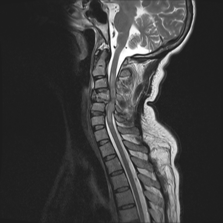 Traumatic Spinal Cord Injury 