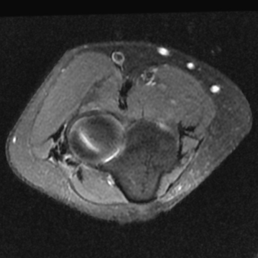 Lateral epicondylitis | Image | Radiopaedia.org