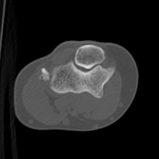 Lateral epicondylitis | Image | Radiopaedia.org