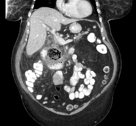 Duodenal diverticulitis | Radiology Reference Article | Radiopaedia.org