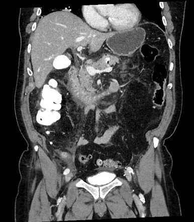 Pancreatitis | Radiology Reference Article | Radiopaedia.org