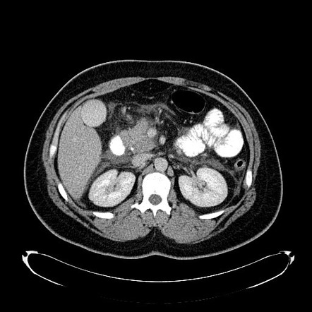 Playlist 'Retroperitoneal pathology' by Dr Wasif Mohammed