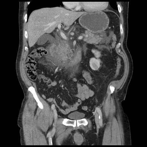 File:Journey through necrotizing pancreatitis - presentation, walled ...