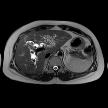 Oriental Cholangiohepatitis 