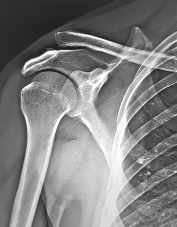 Acromioclavicular injury - Rockwood type III | Radiology Case ...