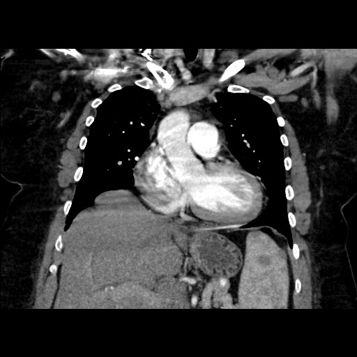 Sarcoidosis in the abdomen and pelvis | Image | Radiopaedia.org