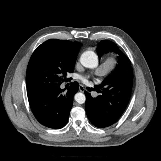 Congenital absence of the left pericardium | Image | Radiopaedia.org