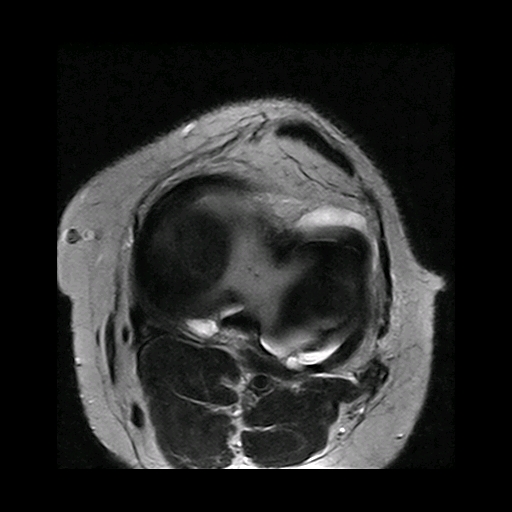 Flipped meniscus | Image | Radiopaedia.org