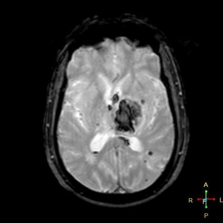 Thalamic hematoma and intraventricular hemorrhage | Radiology Case ...