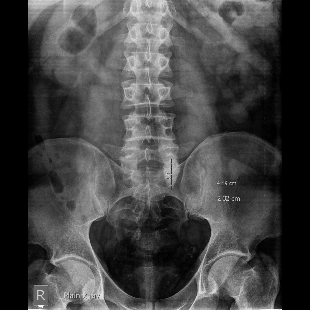 Pelvic Stone In An Ectopic Kidney Radiology Case Radiopaedia Org