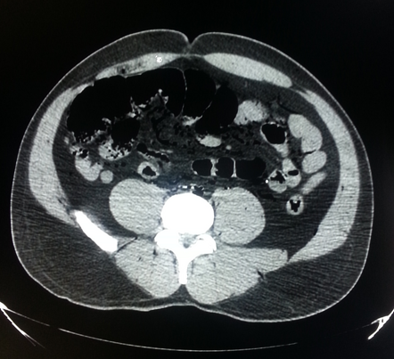 Decompression syndrome in SCUBA diver | Image | Radiopaedia.org