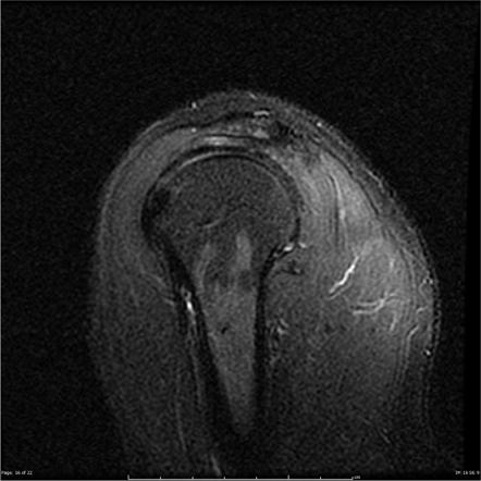 Viewing playlist: Wildcats Shoulder MRI | Radiopaedia.org