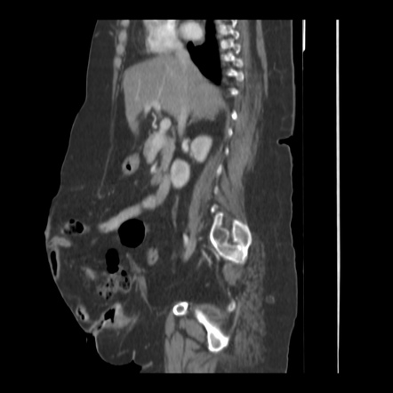 Large ventral hernia with ileal diverticulitis within the hernial sac ...