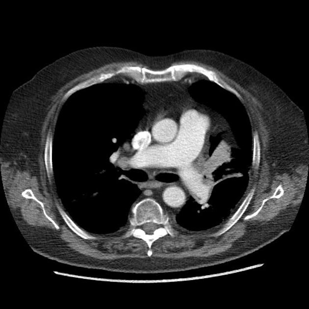 Pneumothorax | Radiology Case | Radiopaedia.org