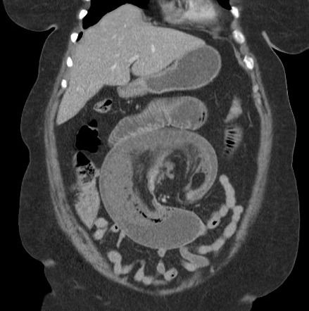 Jejunojejunal Intussusception Image Radiopaedia Org