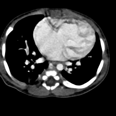 Interrupted aortic arch | Image | Radiopaedia.org