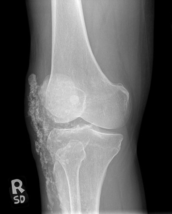 Progressive systemic sclerosis involving the knee | Radiology Case ...