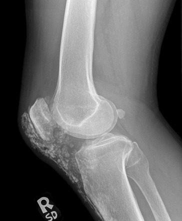 Scleroderma | Radiology Reference Article | Radiopaedia.org