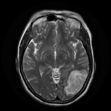 Cerebral venous infarction | Radiology Reference Article | Radiopaedia.org